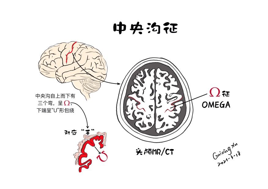 一图展示:中央沟-Omega征 - 脑医汇
